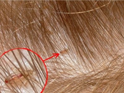 Фото: Головные вши Головные вши