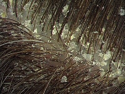 Хлопья отпавшей дермы при себорее