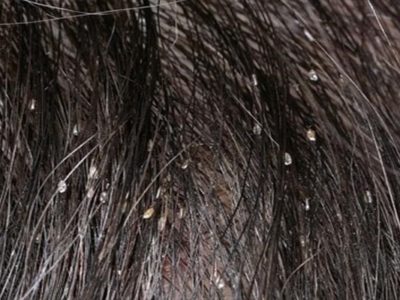 Фото: Яйца вшей, прикрепленные к волосам Яйца вшей, прикрепленные к волосам