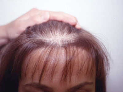 Причина выпадения волос у женщин после 40 лет лечение thumbnail