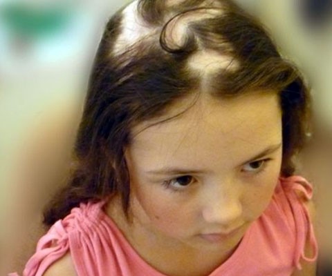 У ребенка 3 года выпадают волосы клоками